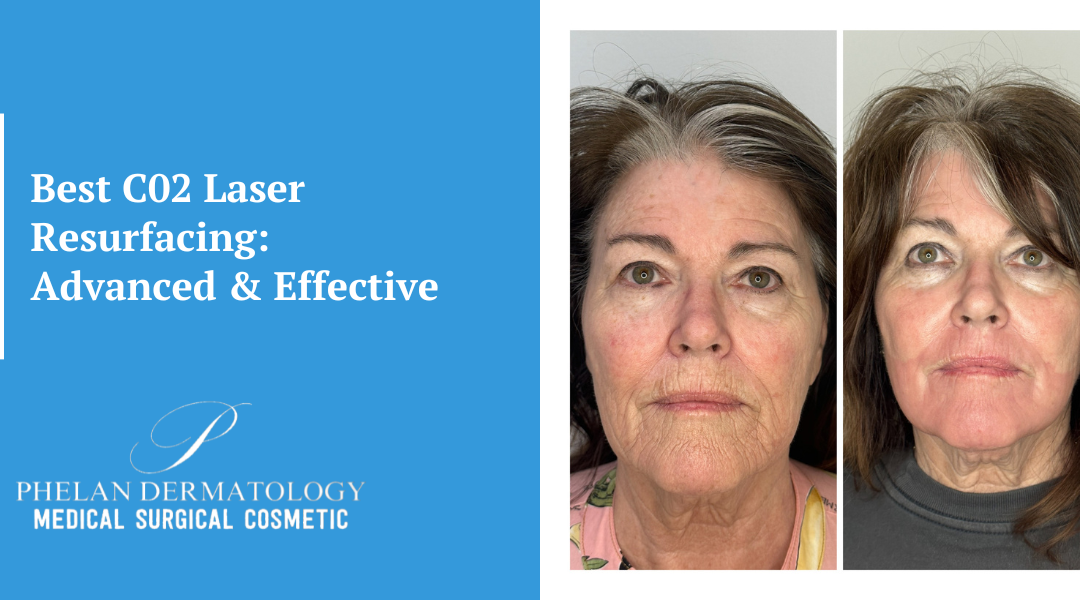 Best C02 Laser Resurfacing: Advanced & Effective