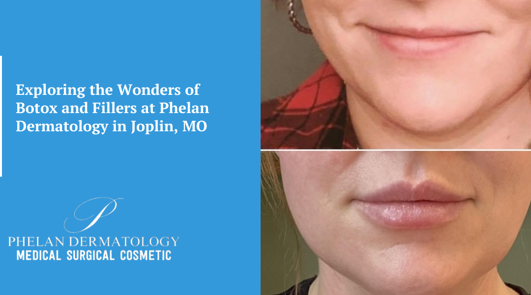 Exploring the Wonders of Botox and Fillers at Phelan Dermatology in Joplin, MO