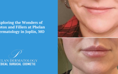 Exploring the Wonders of Botox and Fillers at Phelan Dermatology in Joplin, MO