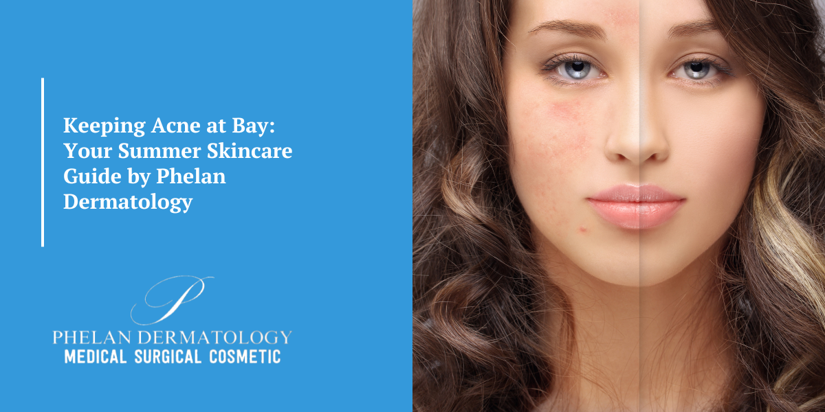 Keeping Acne at Bay: Your Summer Skincare Guide by Phelan Dermatology